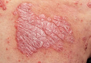 psoriasis